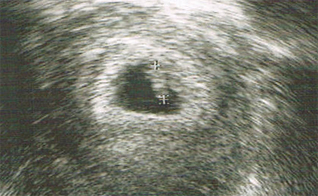 Baby im Bauch - Ultraschallbild Baby im Bauch