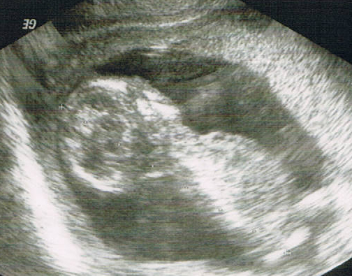 Ultraschallbild Velen 1