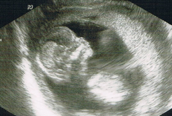 Ultraschallbild Velen 2