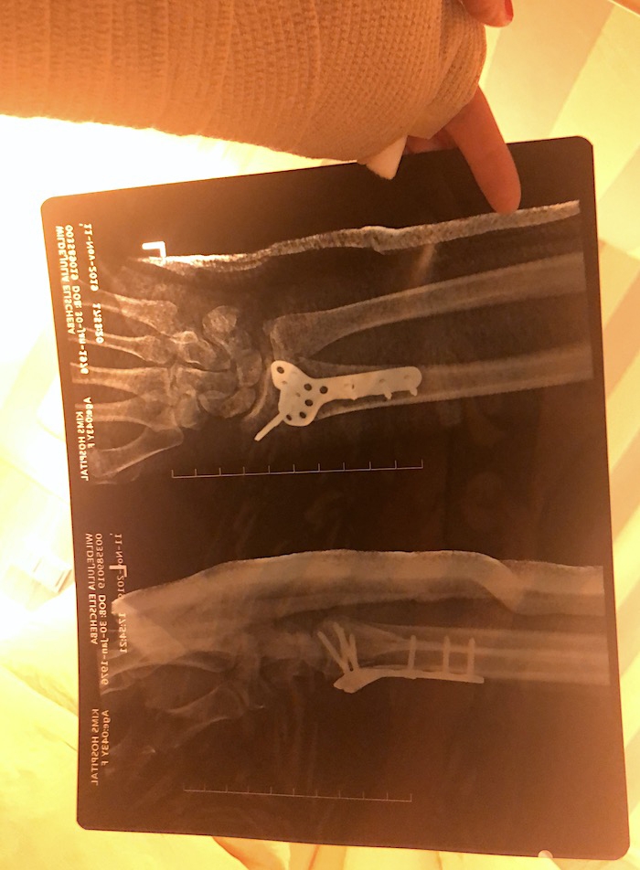 Röntgenbild vom gebrochenen Arm