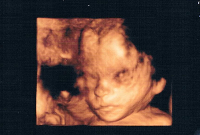 Ultraschallbild von Emily