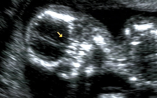 Ultraschallbild - Blick aufs Gehirn des Babys
