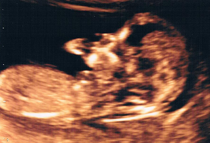 Ultraschallbild in der 13ten Schwangerschaftswoche