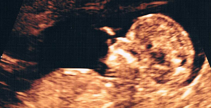Ultraschallbild in der 13ten Schwangerschaftswoche